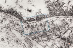 M,2y. | viral particles ? in hepatocyte M,2y. | viral particles ? in hepatocyte